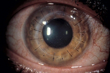 Advanced Corneal Transplant