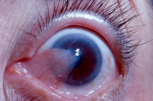 pterygium eye pinguecula tanning tissue corner eyes cornea lesions fibrovascular inflammation connective damage beds disease dr growths grows sanctuary pterygia