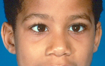Strabismus