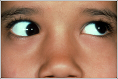 Strabismus ("crossed-eyes") 