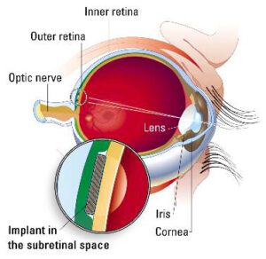  Artificial Retina