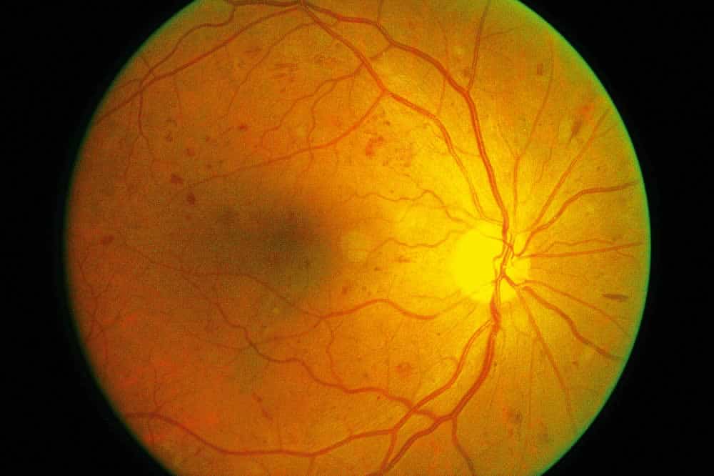 Diabetic Retinopathy