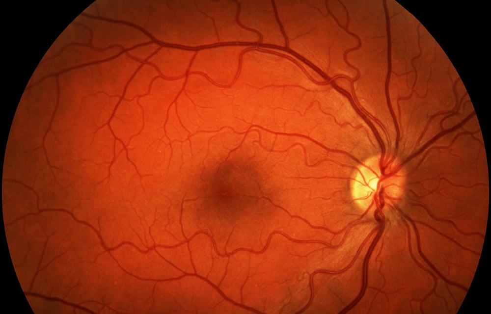 Macular Degeneration