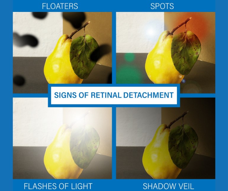 retinal detachment vision