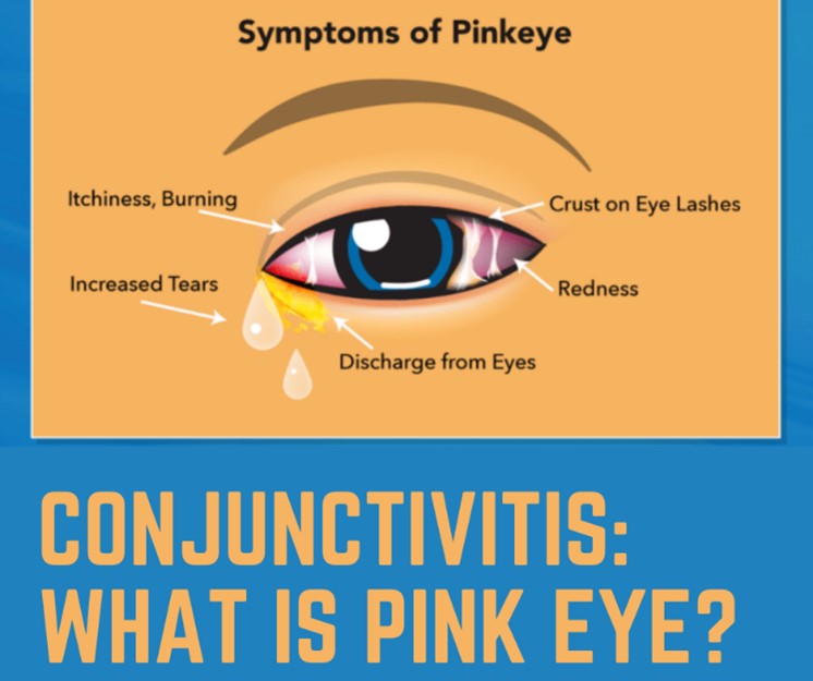 Conjunctivitis: What Is Pink Eye?