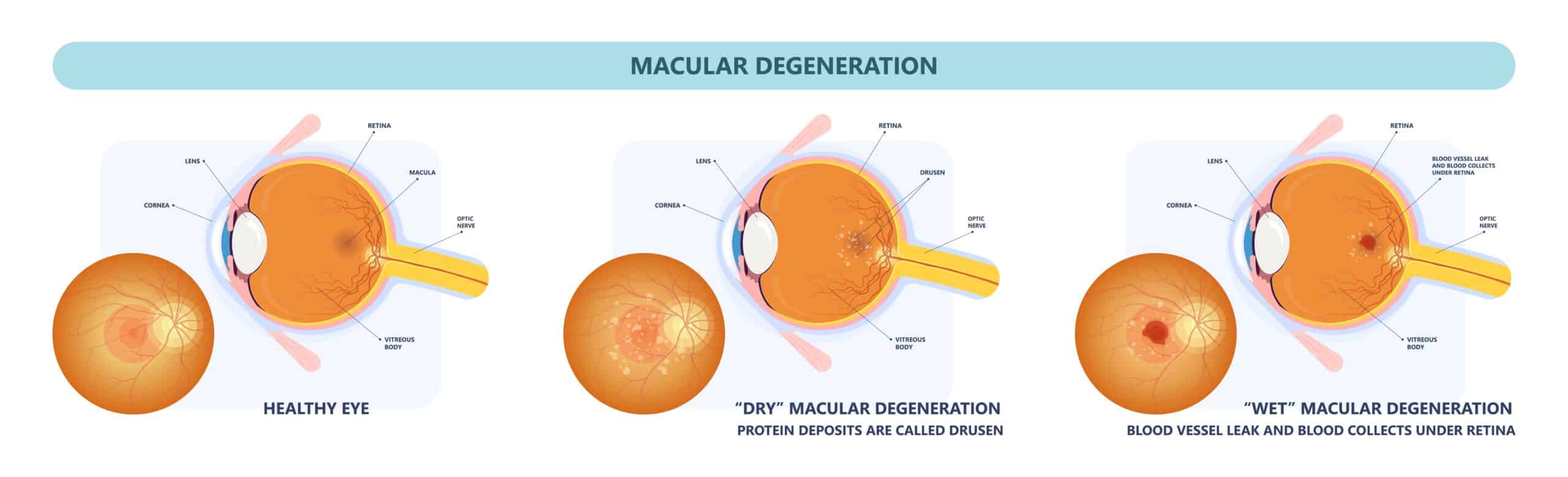 Diagram showing wet and dry macular degeneration.