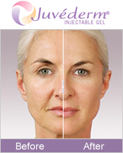 Juvederm